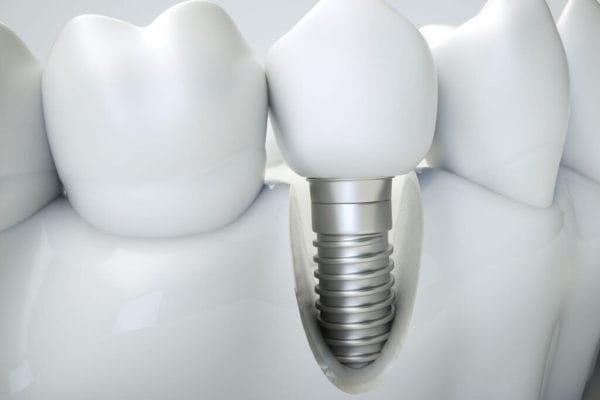 bodrum implant tedavisi en iyi dis hekimi scaled