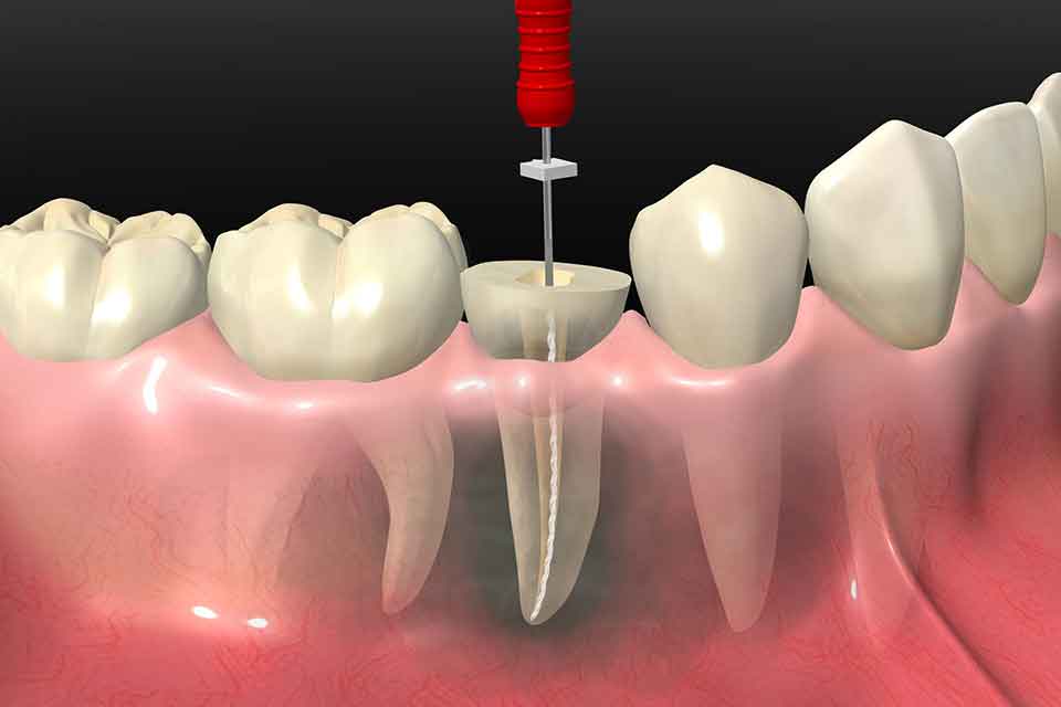 Bodrum Kanal Tedavisi (Endodonti)